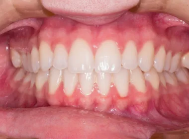 Na czym polega leczenie luźnych zębów?