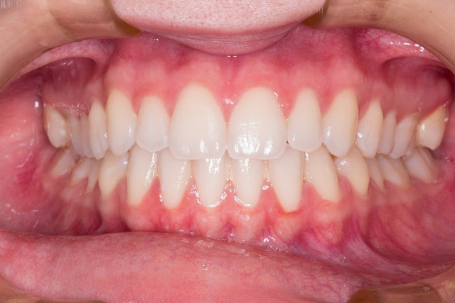 Na czym polega leczenie luźnych zębów?